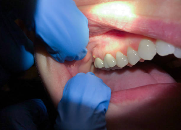 Best Broken or Cracked Tooth Emergency Dentist in Meridian, TX