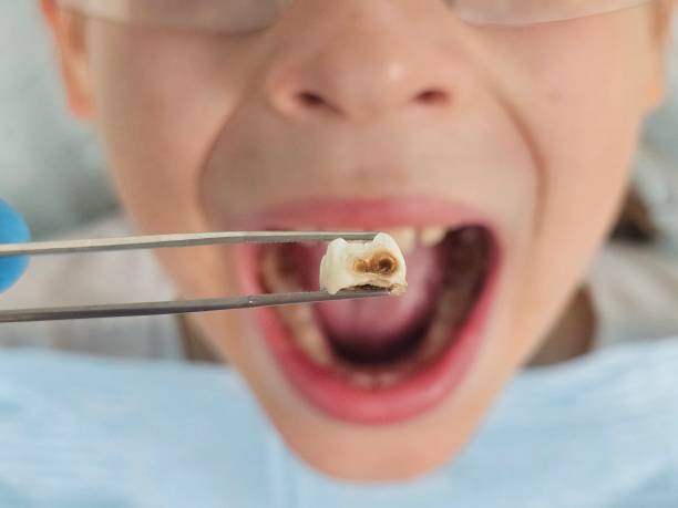 Best Emergency Dental Care for Abscessed Tooth in Meridian, TX